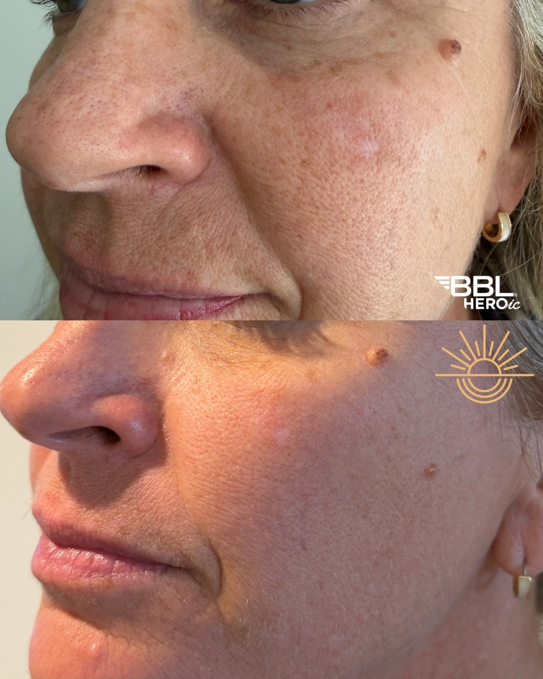 Brighter tone. Fewer sun spots.