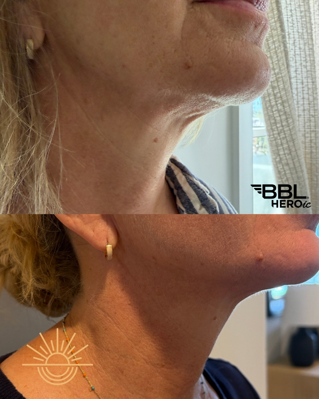 Smoother neck. Firmer jawline.